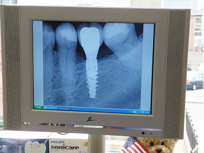 Digital X-Rays as seen by the patients