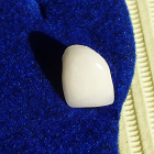 Dental Crowns