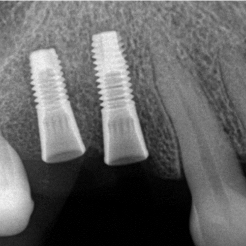 Dental Implants