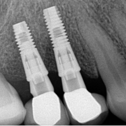 Implant fixture