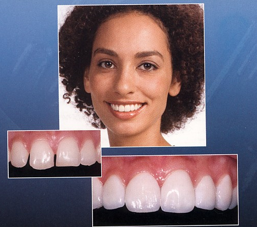 Veneers image 2